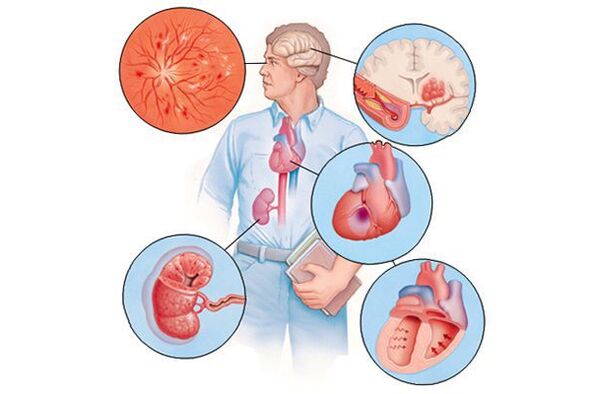 Dommages à différents organes avec une hypertension artérielle plus longue
