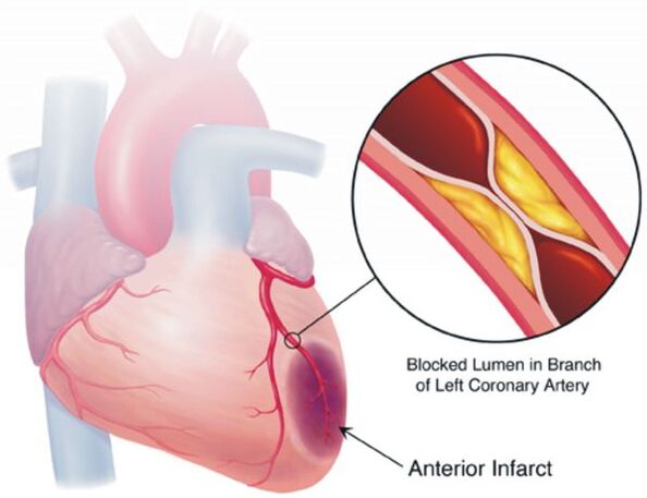 L'une des complications de l'hypertension artérielle est la maladie cardiaque des maladies coronariennes